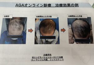 AGAオンライン治療　https://www.ankh-jp.com/ankh-menu-blog/23scalp-cleaning/9664/